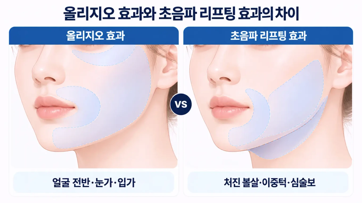 눈가·이마의 얇은 피부와 볼·턱선의 두꺼운 피부·지방층을 나란히 비교한 부위별 피부 단면 모식도