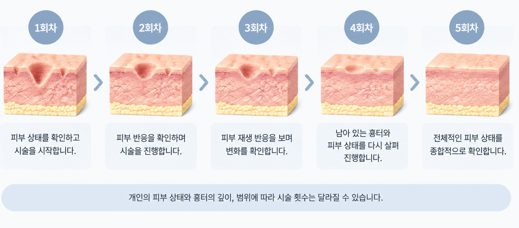 여드름흉터 시술 1회차부터 5회차까지 피부 상태를 확인하는 과정