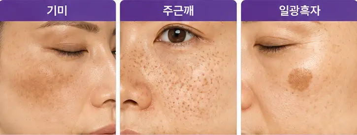 기미·주근깨·일광흑자 등 얼굴 잡티 제거 전 확인해야 할 색소 유형