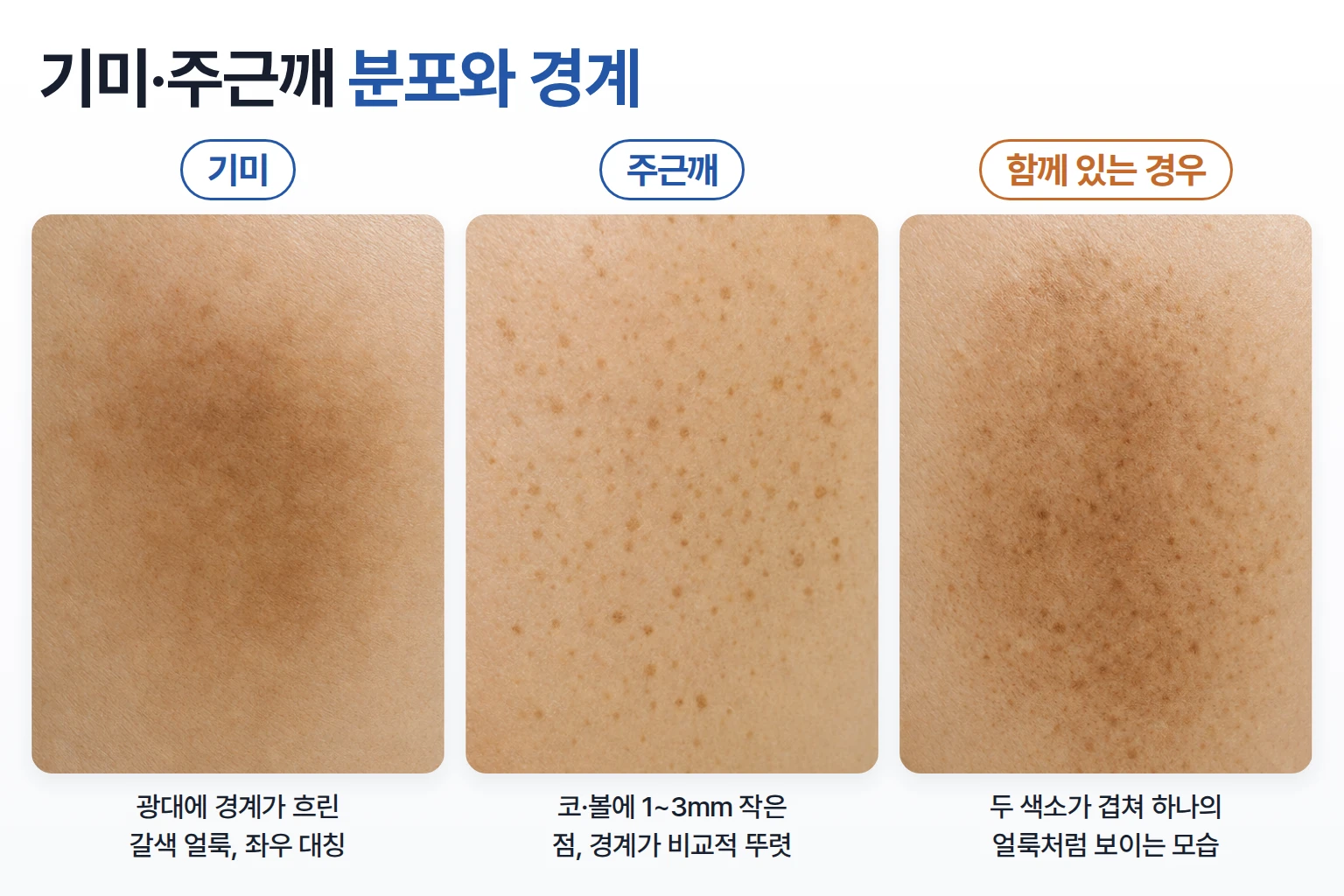 광대에 번진 기미와 코·볼에 흩어진 주근깨, 두 색소가 겹친 모습을 비교한 피부 확대 사진