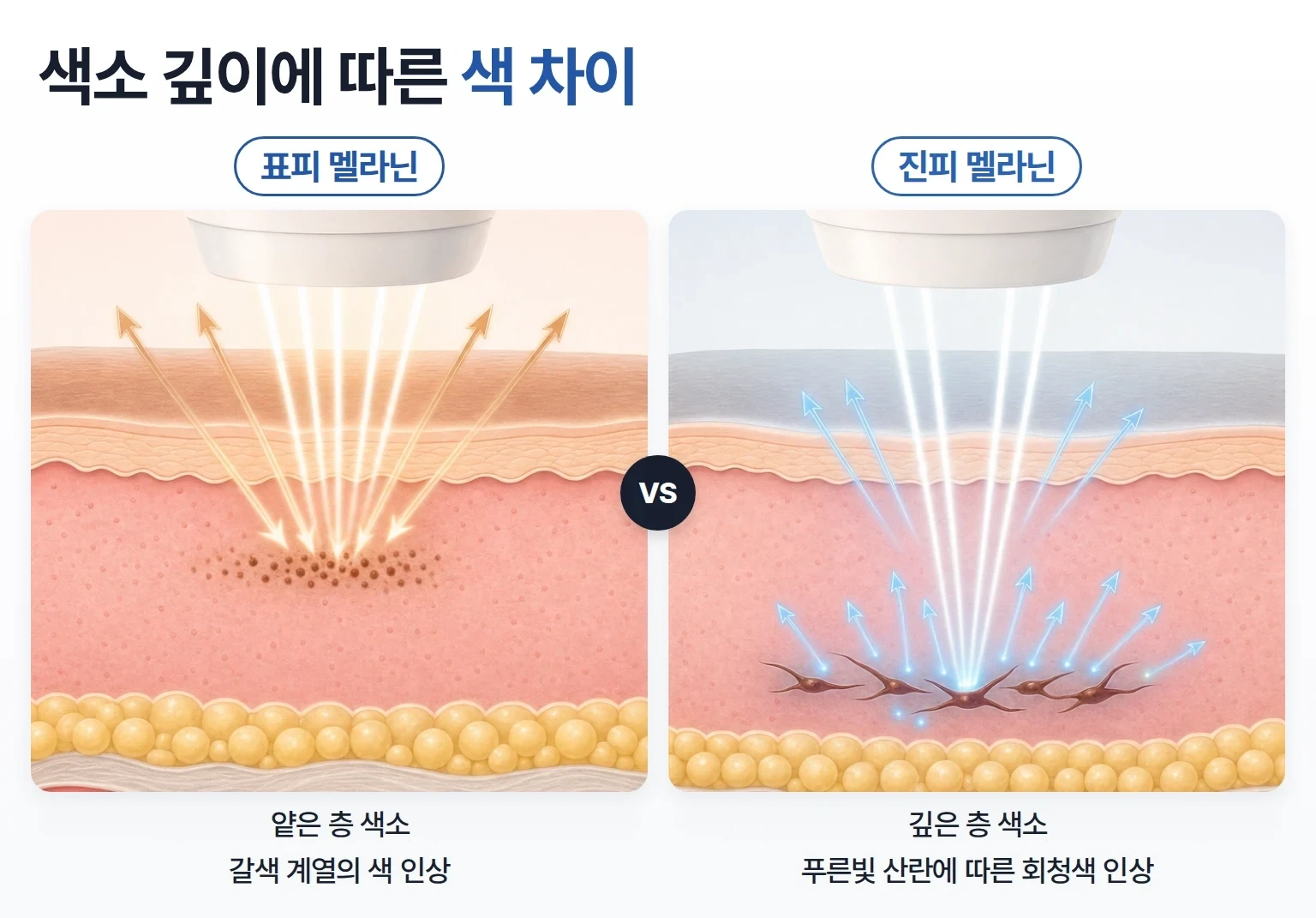 표피 멜라닌의 갈색과 진피 깊은 멜라닌에서 푸른빛이 산란되는 원리를 두 컷으로 비교한 개념도