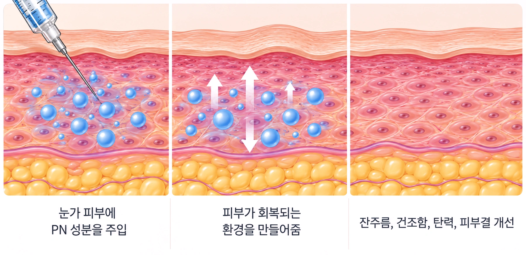 PN 성분을 눈가 피부에 주입해 피부 재생을 돕는 아이 리쥬란 원리