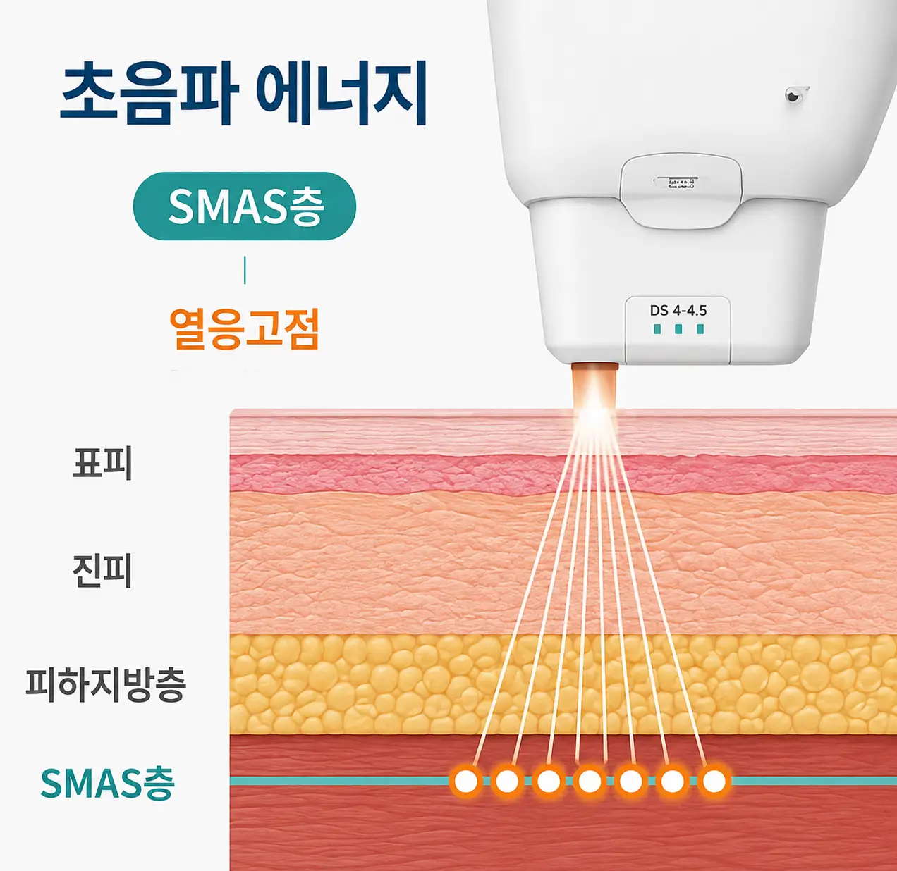 울쎄라 리프팅 초음파 에너지가 SMAS층에 작용하는 원리