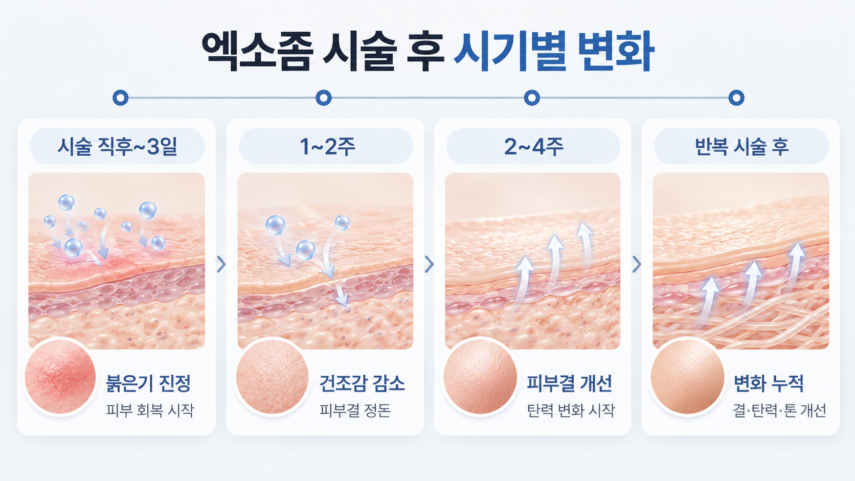 엑소좀 효과의 시술 직후부터 1~2주 2~4주 반복 시술 후 피부 변화
