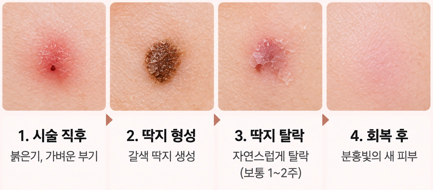 얼굴 검버섯 레이저 시술 직후 붉은기와 부기부터 딱지 형성, 자연 탈락, 피부 회복까지의 변화를 4단계로 정리한 피부 확대 비교 사진