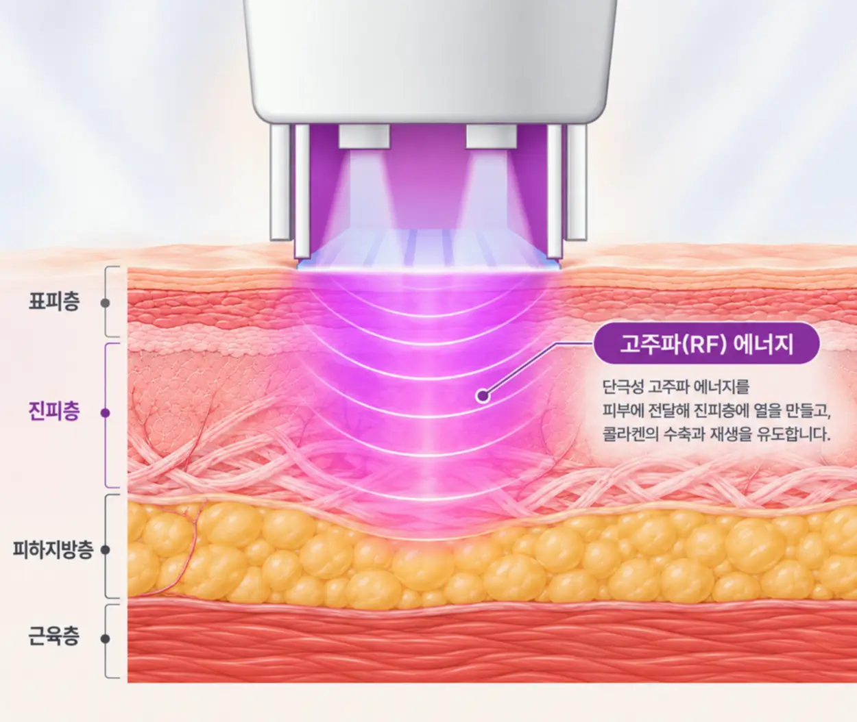써마지 팁이 표피를 냉각하는 동안 고주파 열이 진피층에 넓게 퍼지는 에너지 전달 일러스트