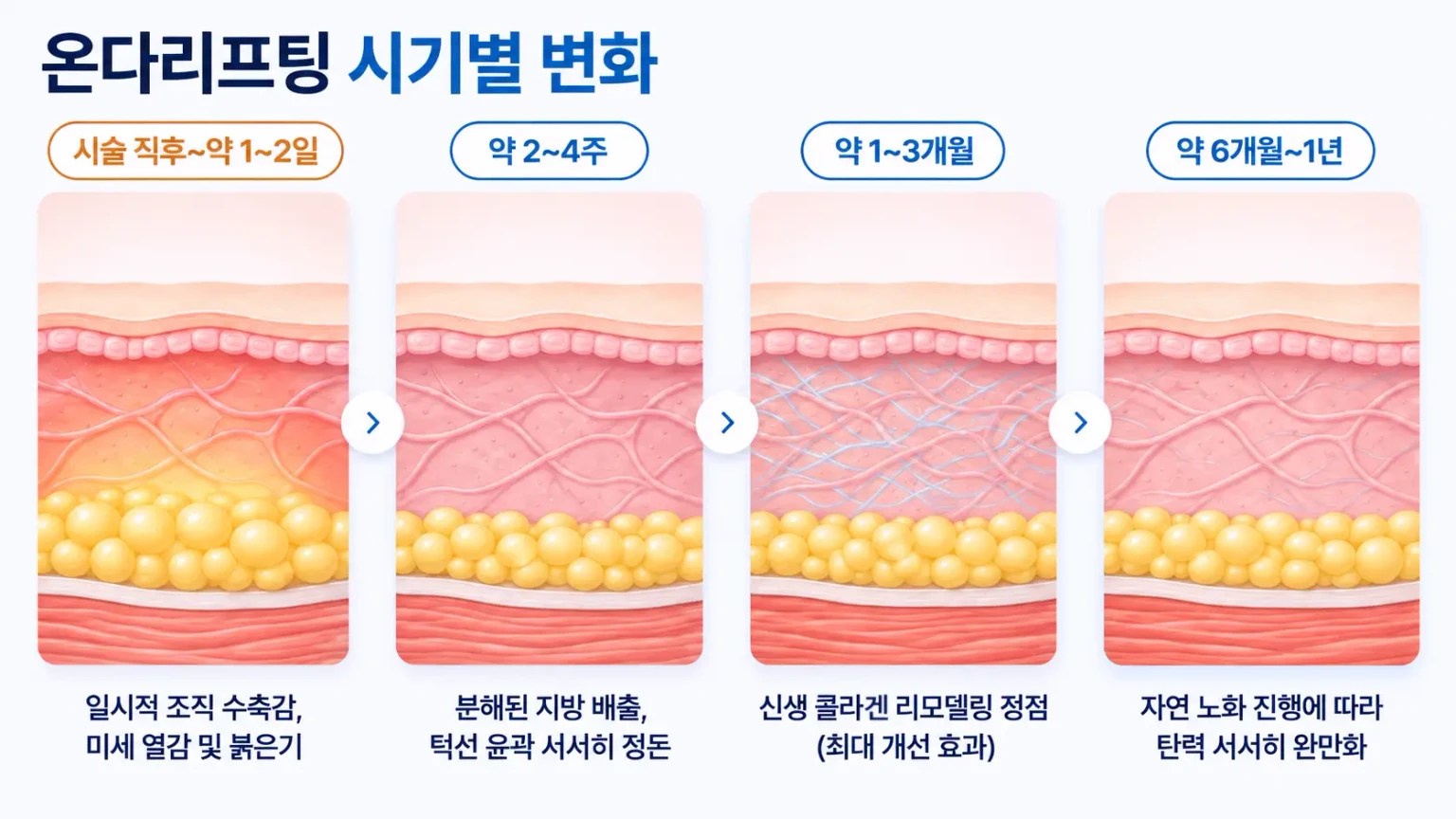 시술 직후부터 수개월까지 지방세포 크기와 진피 콜라겐 변화를 4단계로 나타낸 피부 단면 일러스트