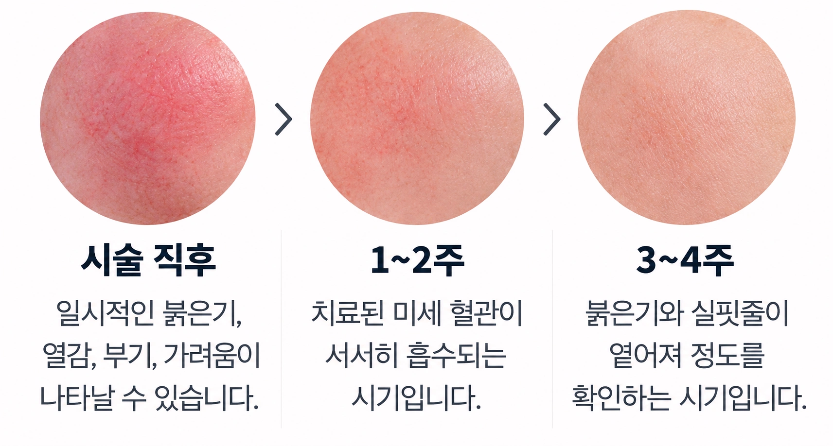 홍조 레이저 시술 직후부터 3~4주까지의 피부 변화 과정