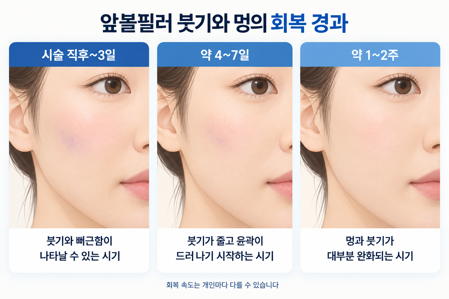 앞볼필러 후 초기 3일간의 붓기와 멍, 4~7일경 붓기 감소, 1~2주에 걸친 회복 경과를 비교한 앞볼 피부 상태