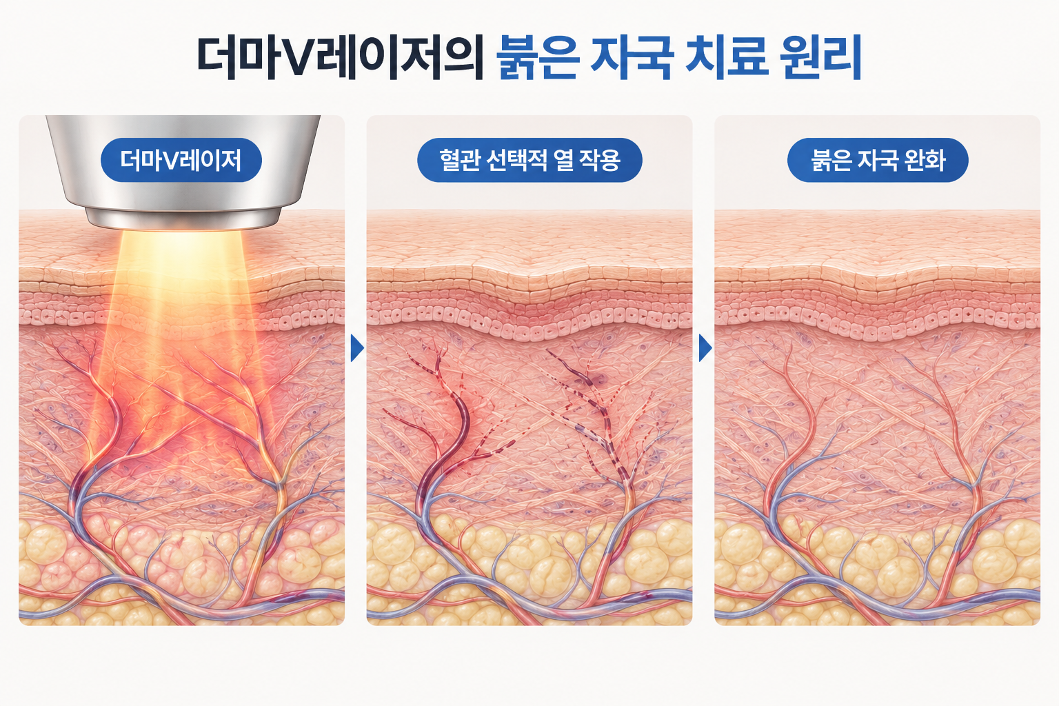 더마V레이저 혈관 선택적 열 작용과 붉은 여드름 자국 완화 과정