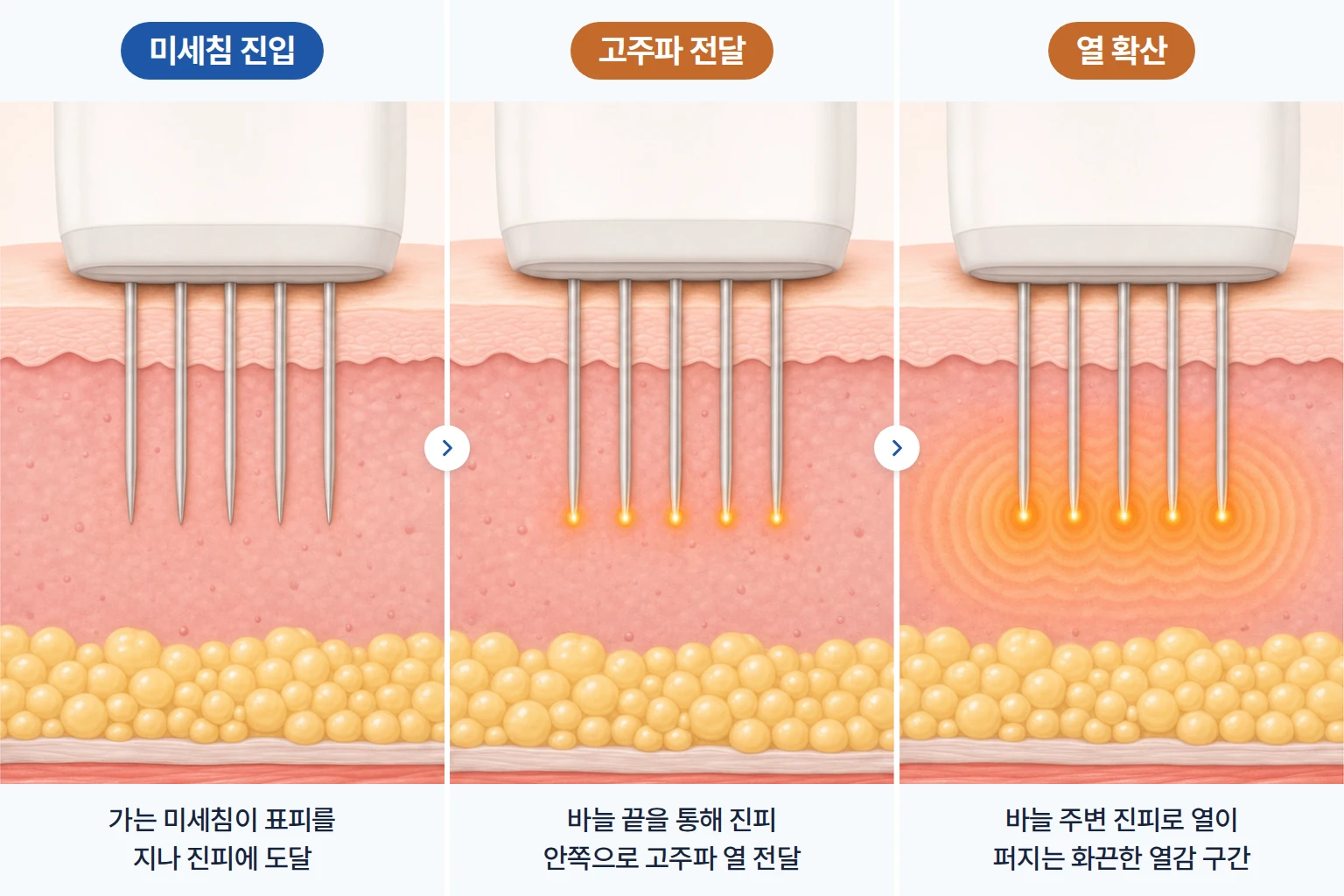 미세침 진입, 고주파 전달, 진피 내 열 확산을 단계별로 나타낸 포텐자 피부 단면 일러스트