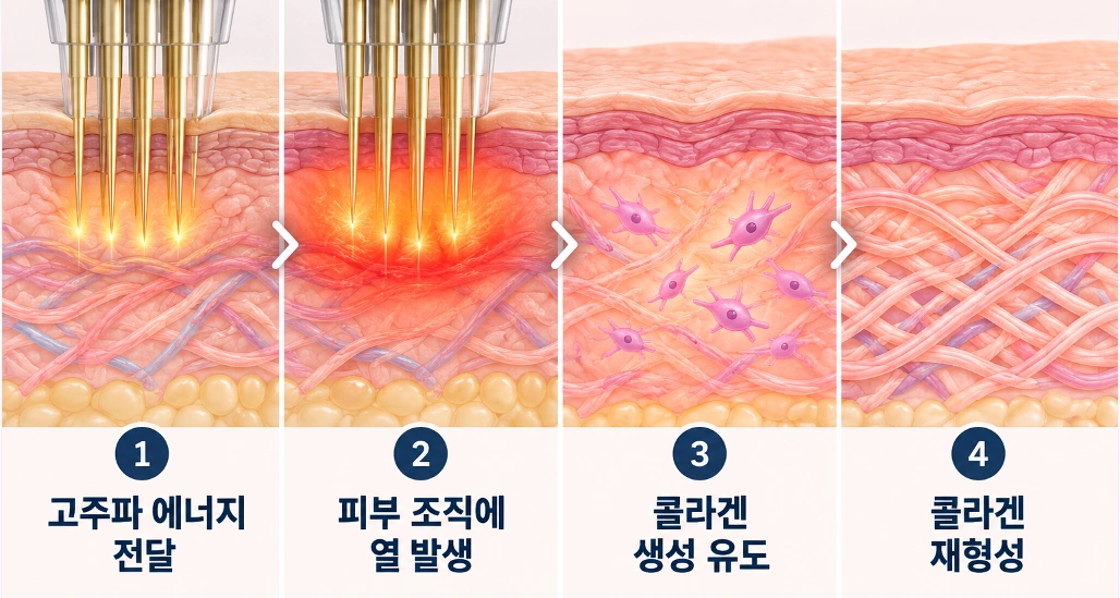 포텐자 마이크로니들 고주파 에너지 전달부터 피부 조직의 열 발생, 콜라겐 생성 및 재형성까지 4단계 원리를 나타낸 피부 단면도