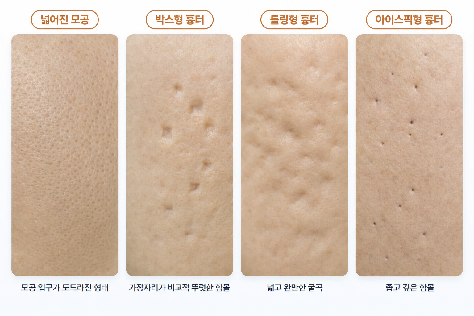 포텐자 시술 시 구분하는 넓어진 모공과 여드름 흉터 유형별 피부 표면으로, 각진 박스형 흉터, 완만한 롤링형 흉터, 좁고 깊은 아이스픽형 흉터의 차이