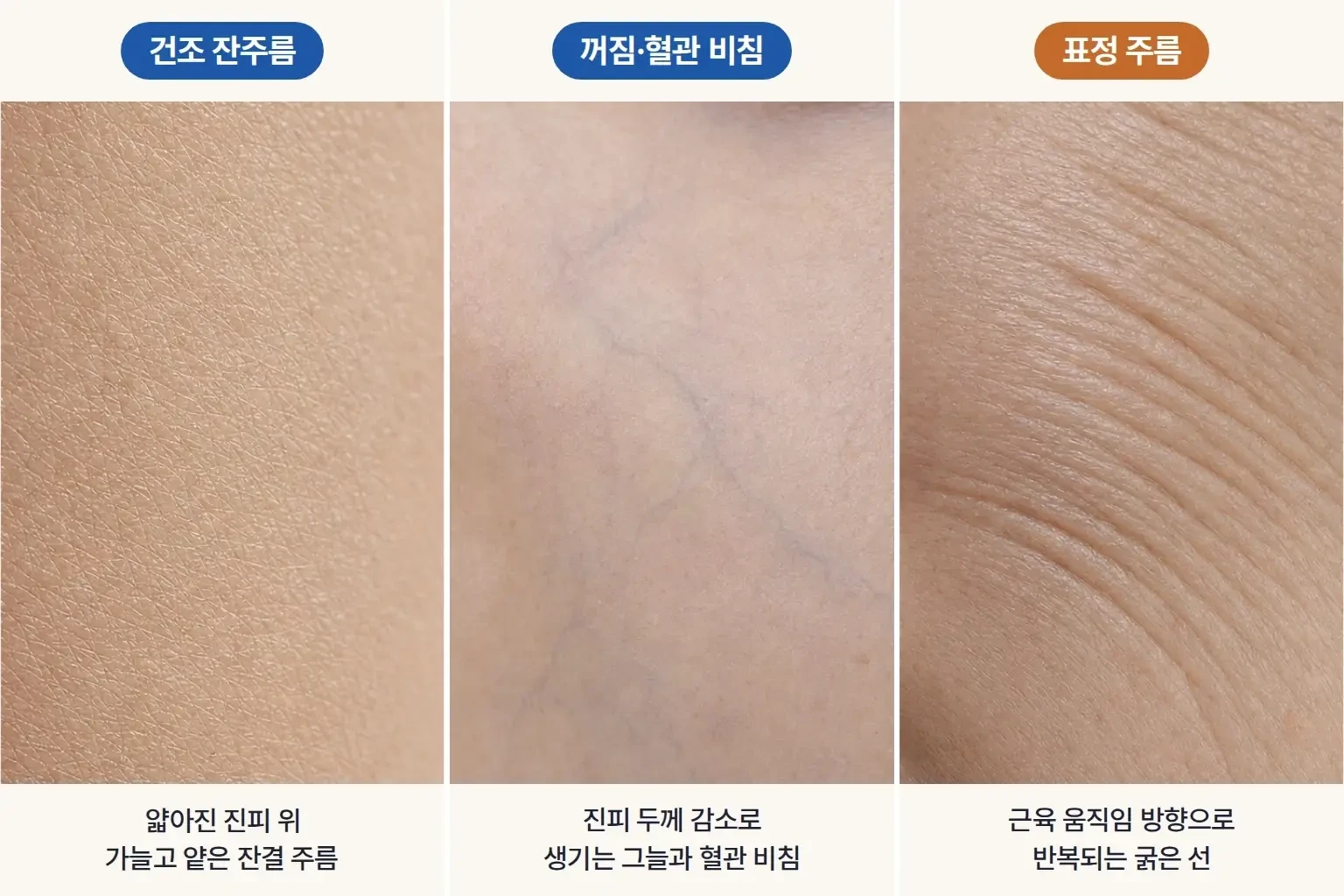 얇아진 피부의 건조 잔주름, 꺼짐 그늘, 표정 주름 외형을 같은 배율로 담은 피부 표면 비교 사진