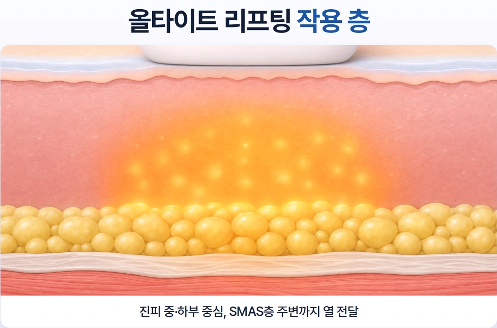 올타이트 리프팅의 진피 중·하부와 SMAS층 주변까지 열에너지가 전달되는 작용 범위를 나타낸 피부 단면도