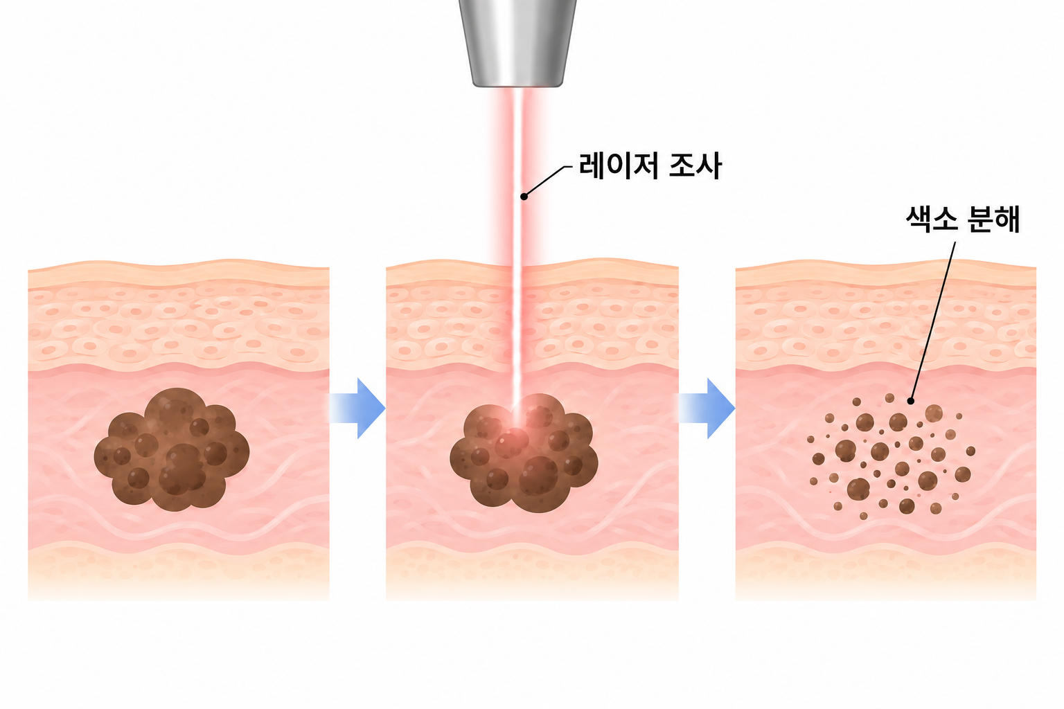 피코토닝 레이저가 멜라닌 색소를 잘게 분해하는 원리 도식