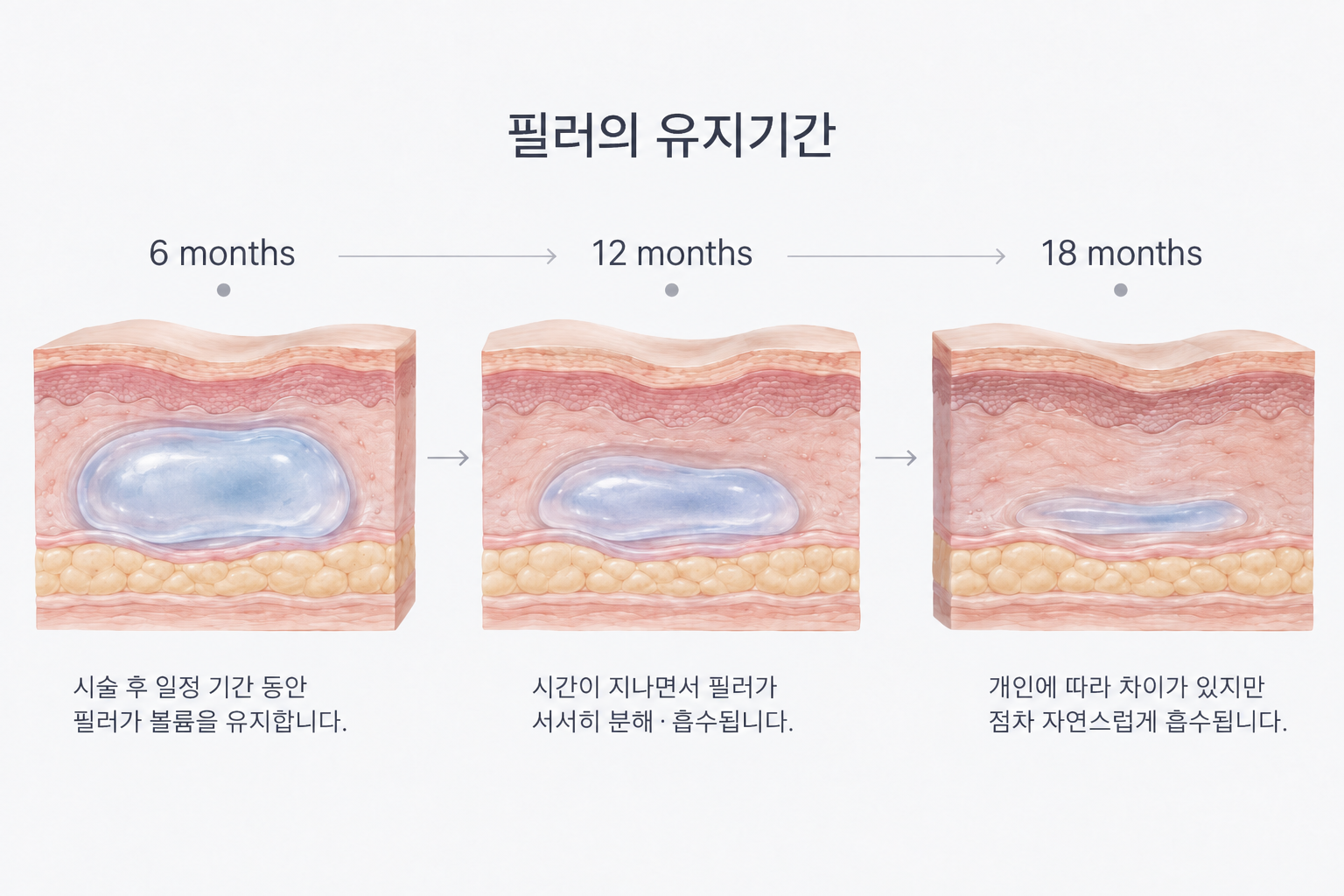 시간이 지나며 히알루론산 필러가 서서히 분해·흡수되는 유지기간 변화