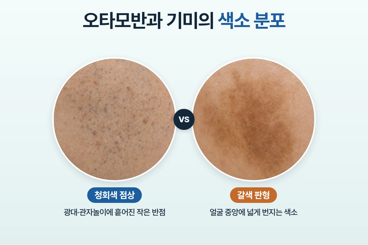 오타모반의 청회색 점상 색소와 기미의 갈색 판형 색소 비교
