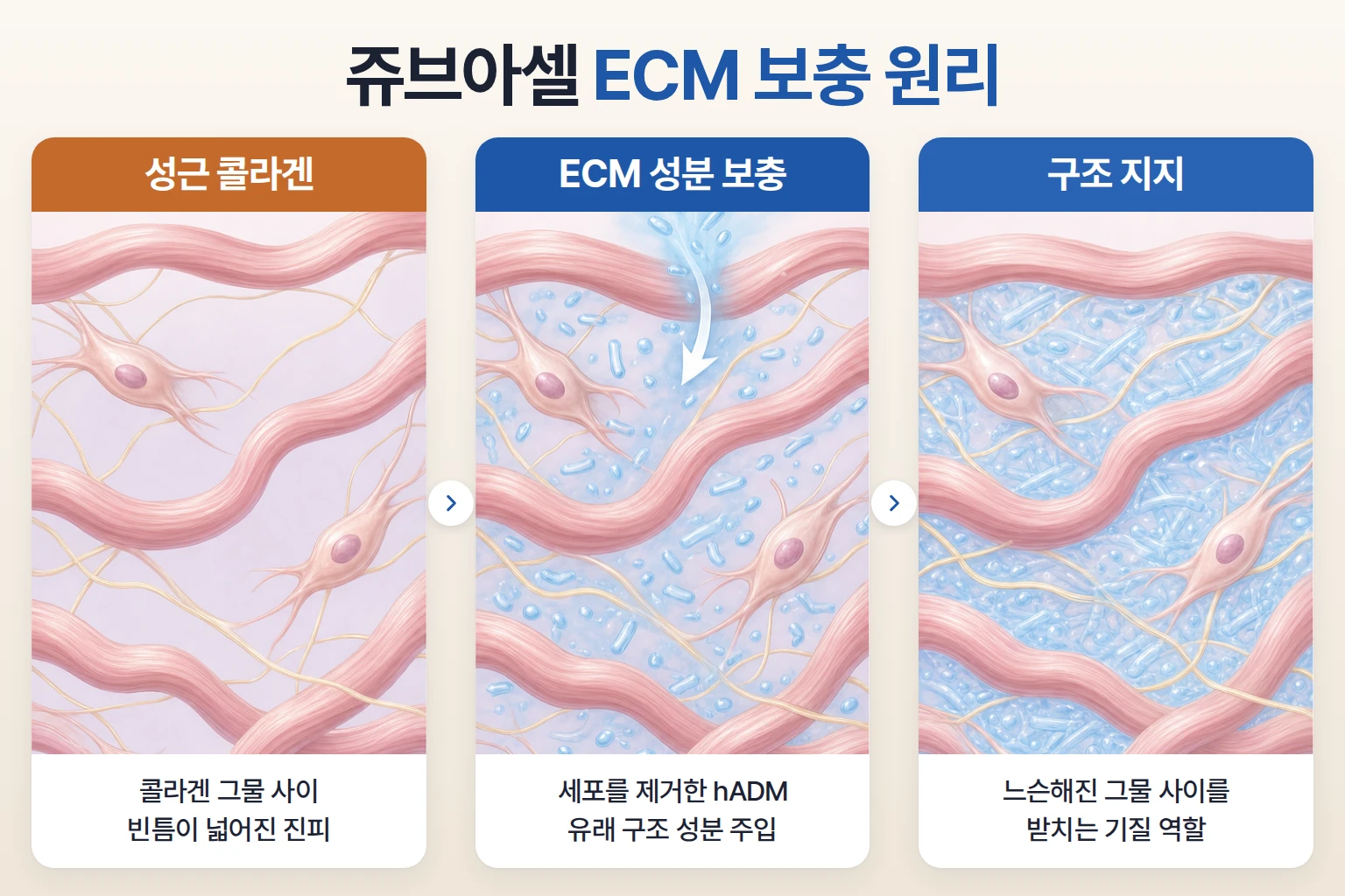 성근 콜라겐 그물 사이에 무세포 동종진피 유래 ECM 성분이 자리 잡는 과정을 그린 개념도