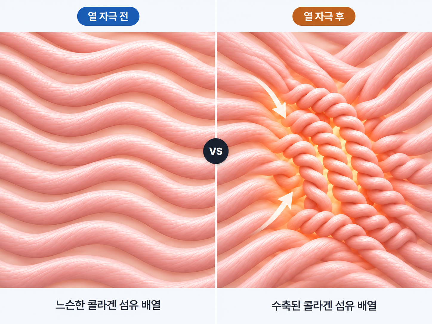 열 자극 전후 느슨한 콜라겐 섬유와 수축된 콜라겐 섬유 비교