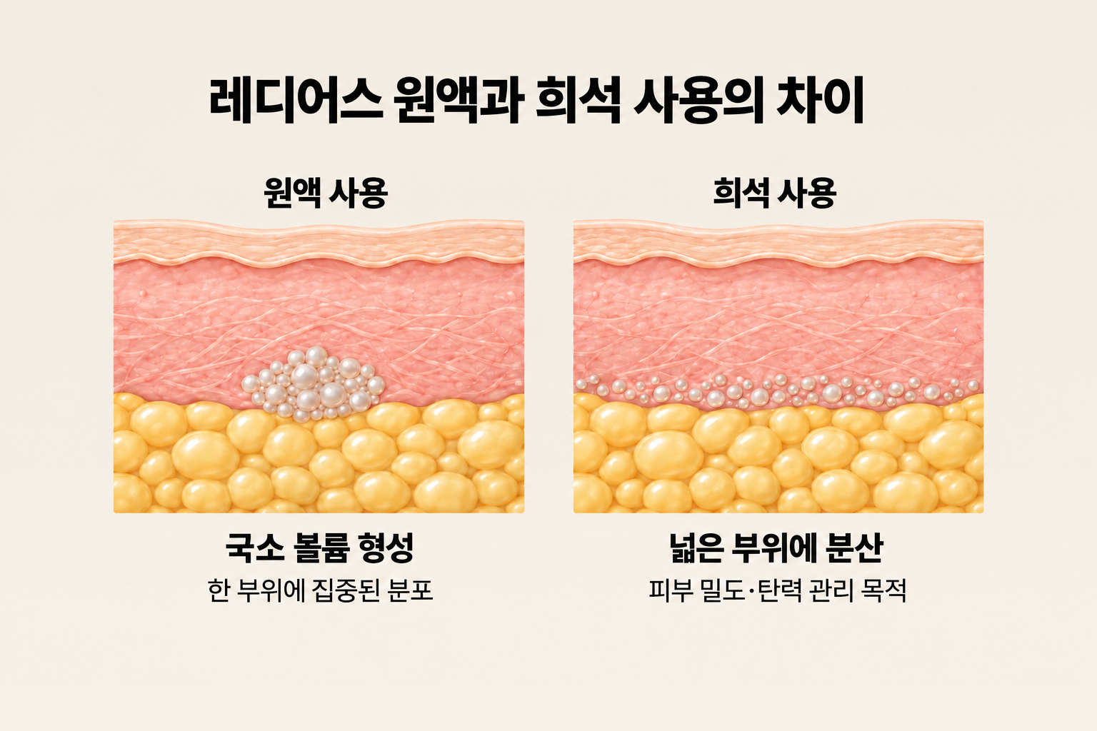 레디어스 원액의 국소 분포와 희석 제형의 넓고 얇은 분포를 비교한 피부 단면도