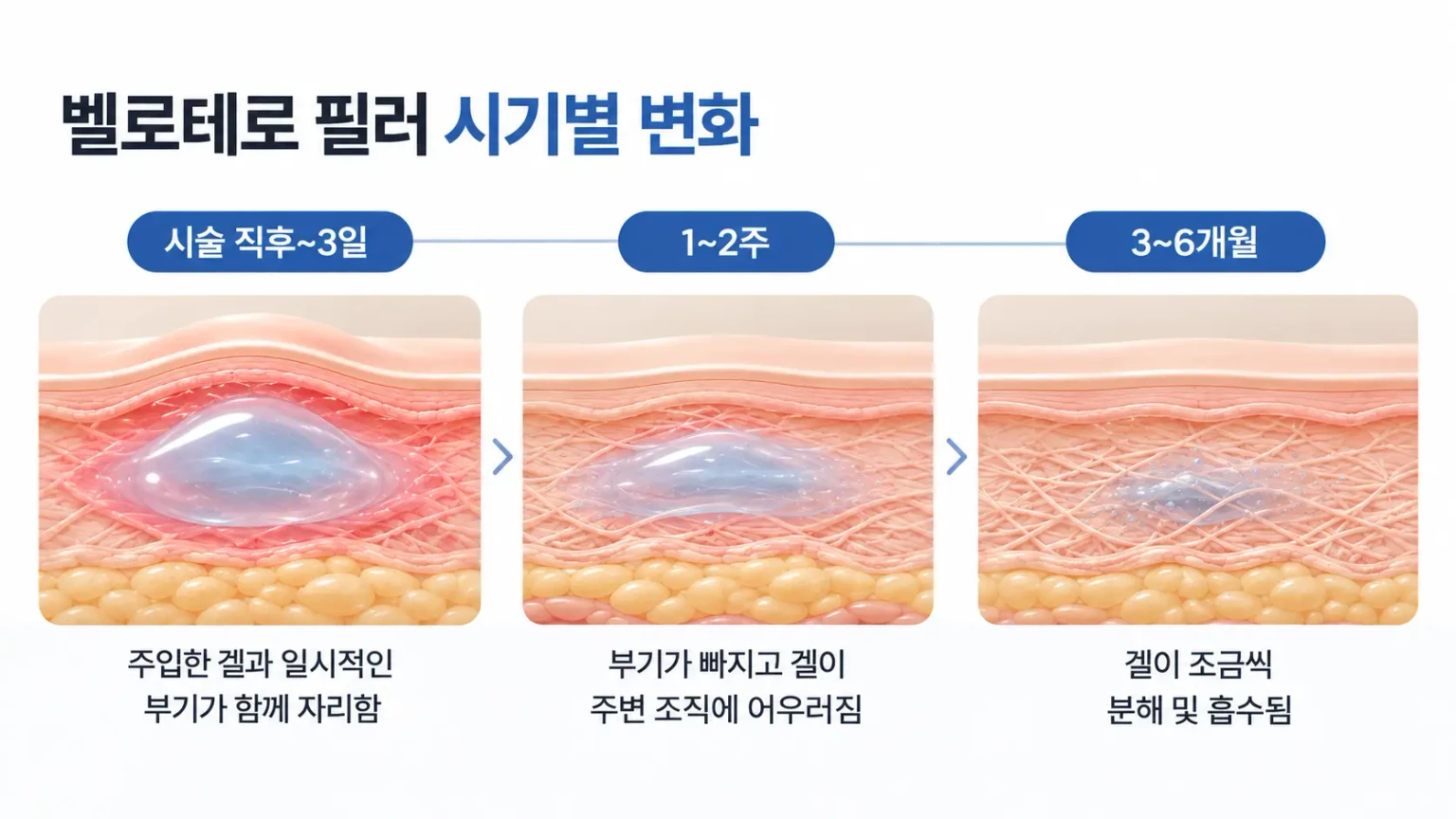 시술 직후부터 유지 기간 후반까지 벨로테로 필러 겔과 볼륨 변화를 시기별로 정리한 타임라인