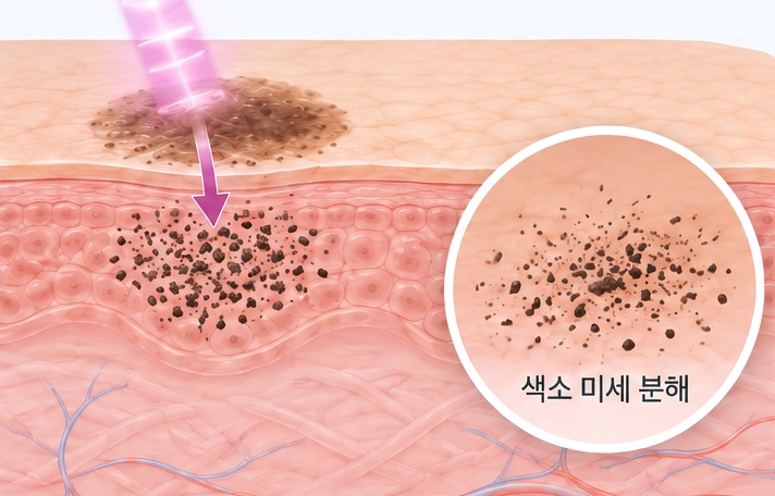피코초 레이저로 검버섯 색소를 미세하게 분해하는 피코슈어 원리