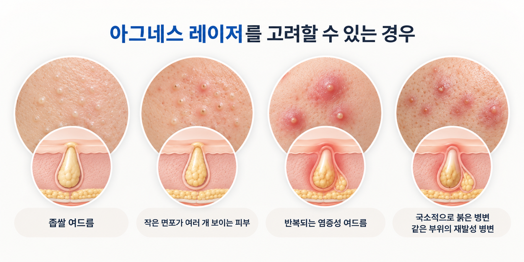 좁쌀 여드름과 염증성 여드름 반복성 병변의 피지선 상태