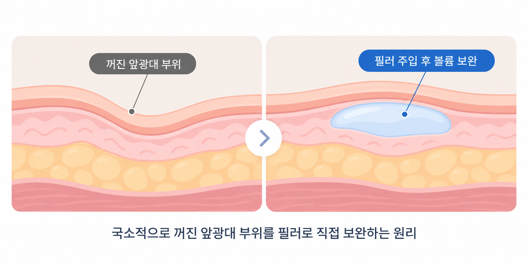 국소적으로 꺼진 앞광대 부위를 필러로 직접 보완하는 원리