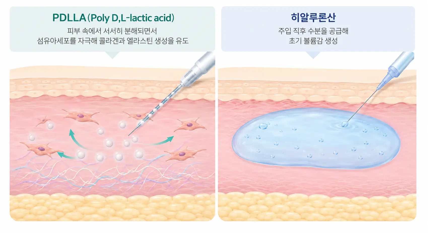 구로 피부과_ 쥬베룩 볼륨의 PDLLA와 히알루론산 작용 원리