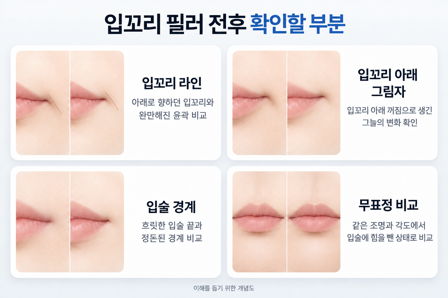 입꼬리 필러 전후 비교에서 확인하는 입꼬리 기울기, 입꼬리 아래 그림자, 입술 경계의 변화와 무표정 상태의 입술 윤곽