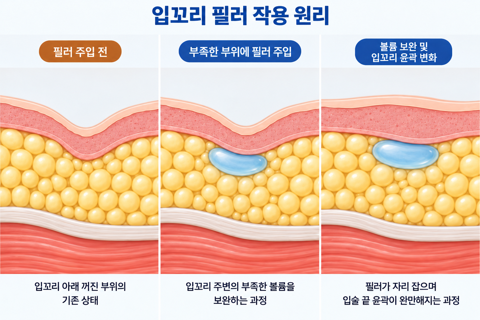 입꼬리 필러 주입 전 꺼진 조직과 히알루론산 필러 주입 후 볼륨이 형성되어 입술 끝 윤곽이 완만해지는 3단계 단면 구조