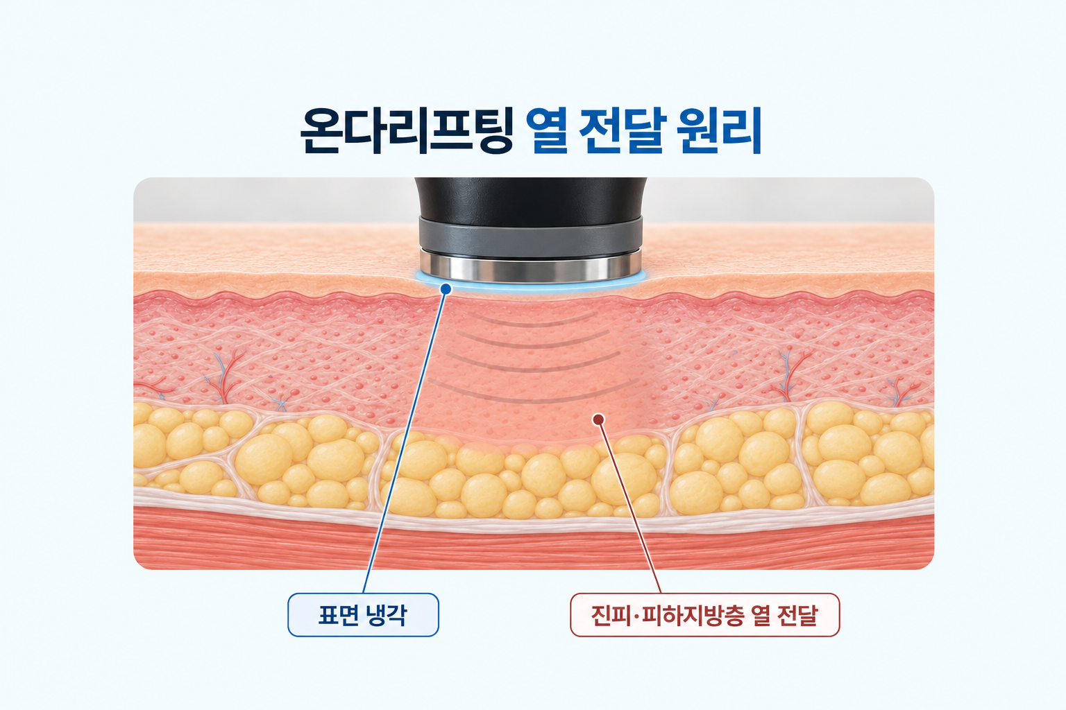 온다리프팅의 피부 표면 냉각과 진피 및 피하지방층 열에너지 전달 원리를 설명한 피부 단면도