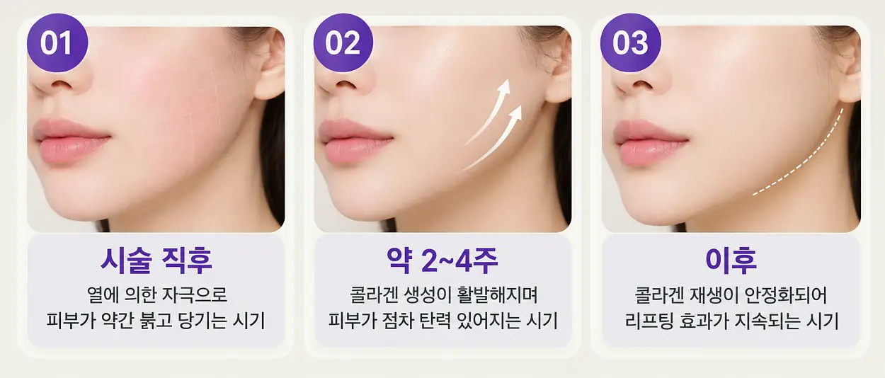 슈링크 효과 시술 후 나타나는 시기 - 4주 이후까지 정리
