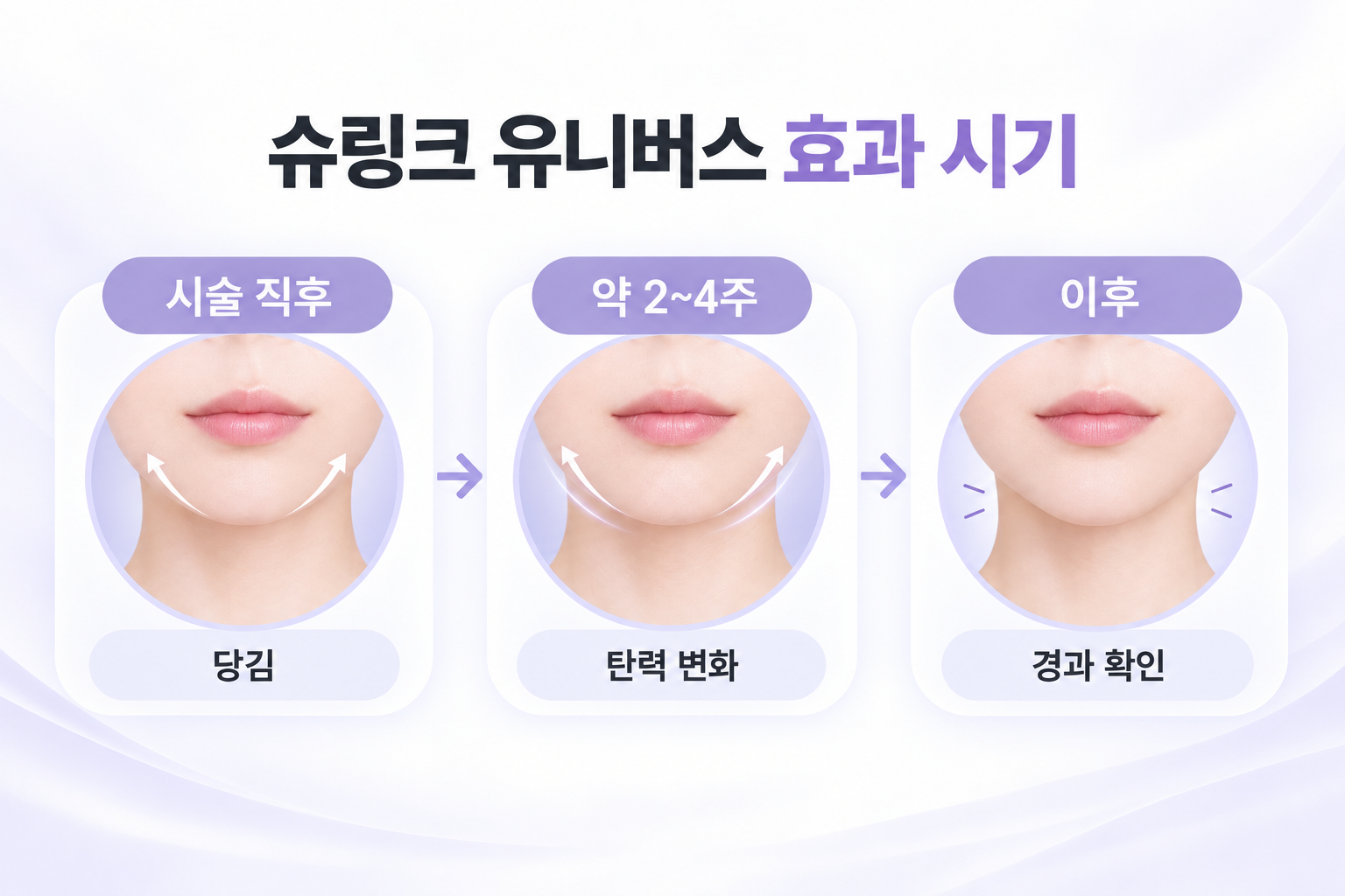 슈링크 유니버스 효과 시기를 시술 직후, 약 2~4주, 이후로 정리한 타임라인
