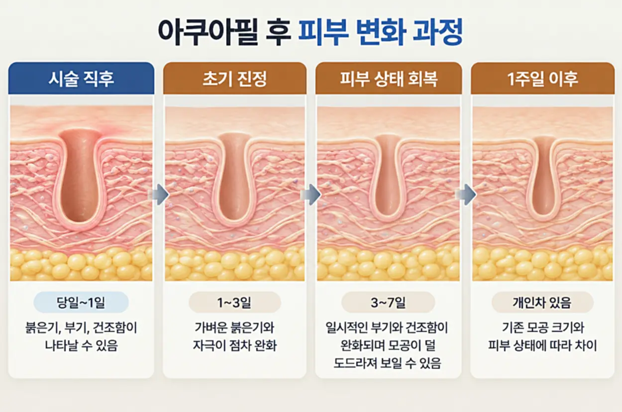 아쿠아필 모공 넓어짐 회복 기간을 설명하는 타임라인