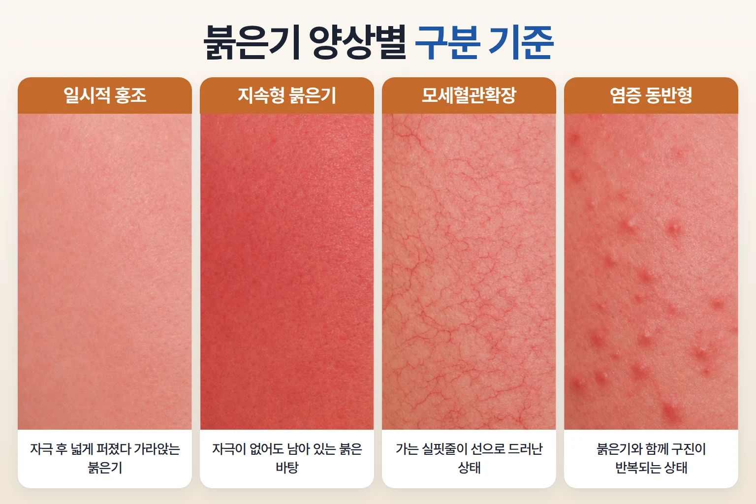 안면홍조 일시적 홍조 지속형 붉은기 모세혈관확장 염증 동반형 비교
