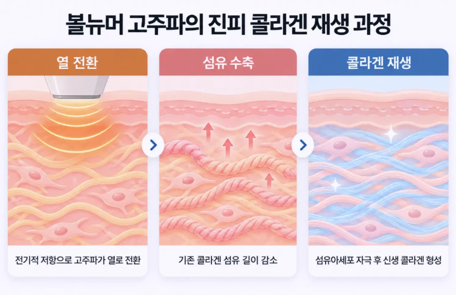 고주파 열 전환, 콜라겐 섬유 수축, 신생 콜라겐 생성 과정을 단계별로 나타낸 개념도
