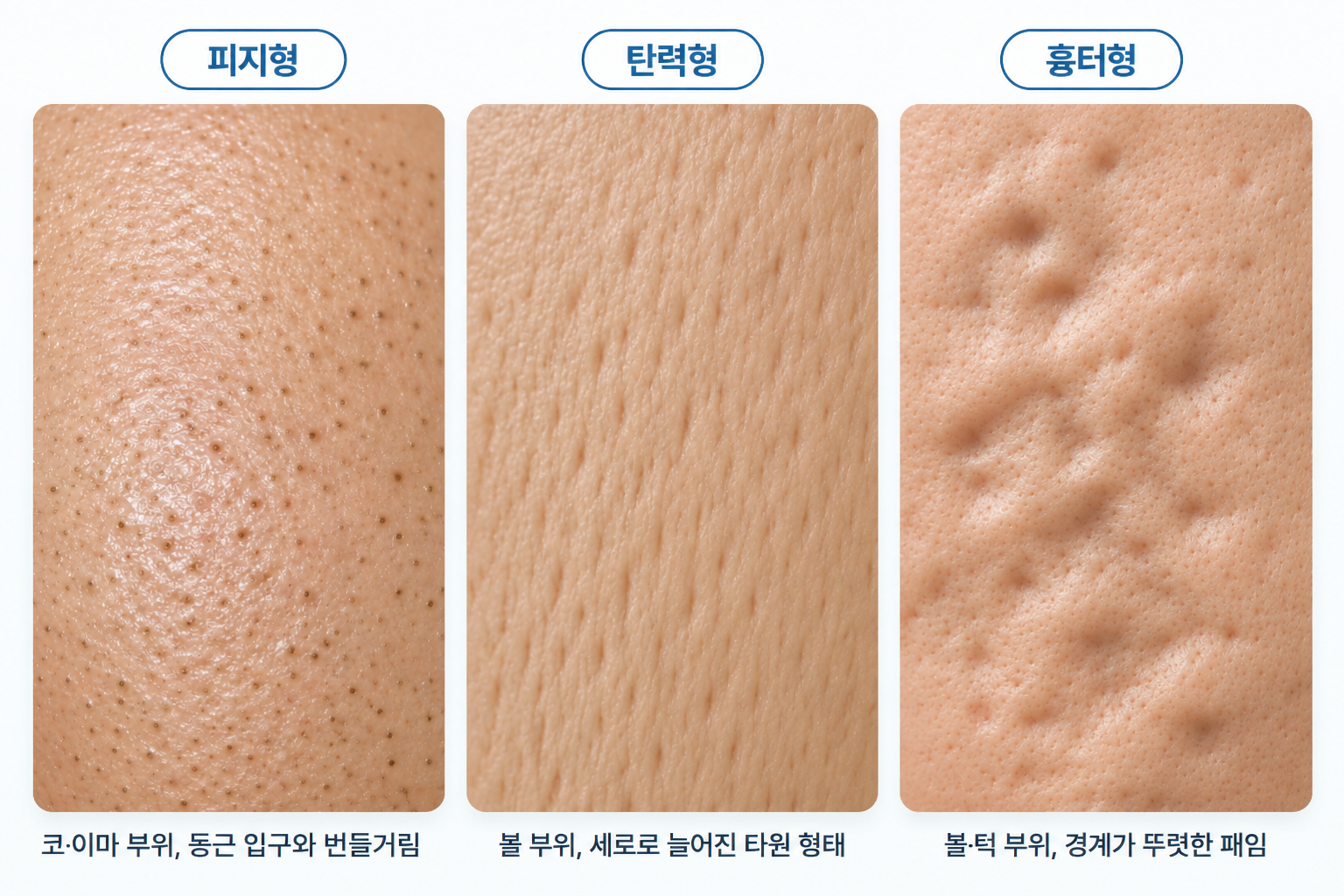 터형-모공-비교피지형 탄력형 흉터형 모공의 피부 표면 차이