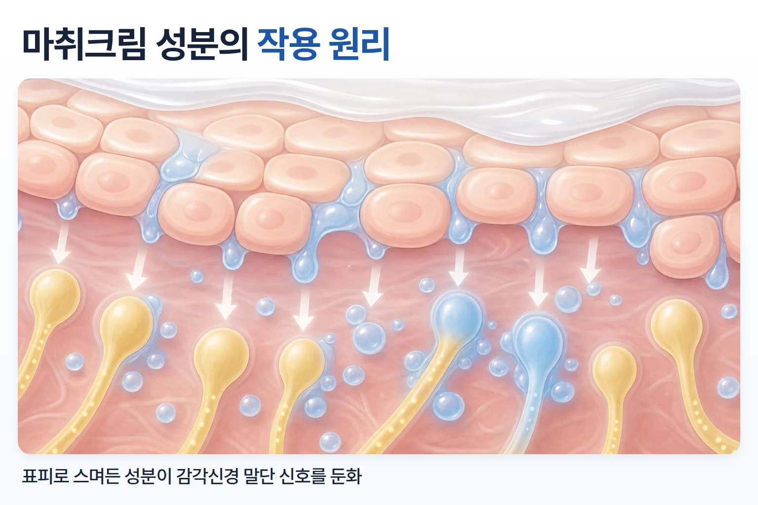 마취크림 성분이 표피로 스며들어 감각신경 말단의 신호 전달을 둔화시키는 원리를 나타낸 개념도