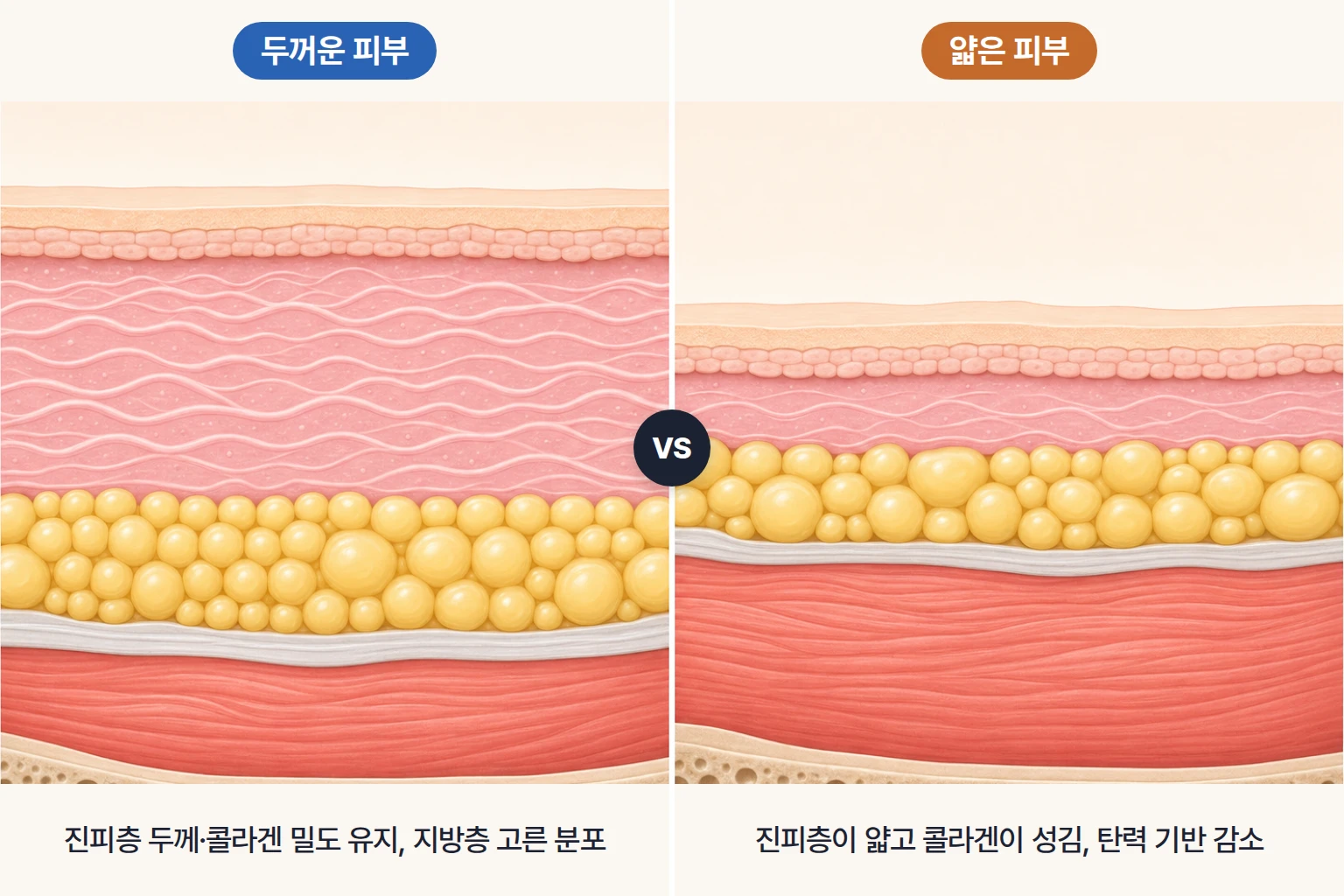 두꺼운 피부와 얇은 피부의 진피 두께, 피하지방층 분포를 동일 배율로 비교한 피부 단면도