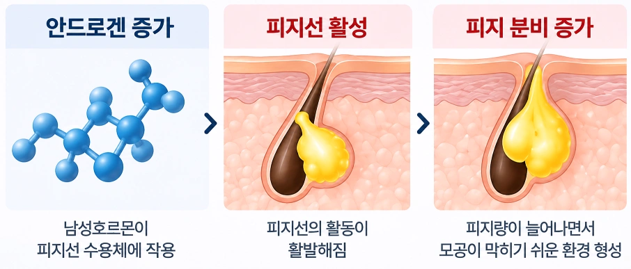 안드로겐 자극으로 피지선이 활성화되고 피지 분비가 증가하는 과정의 피부 단면도