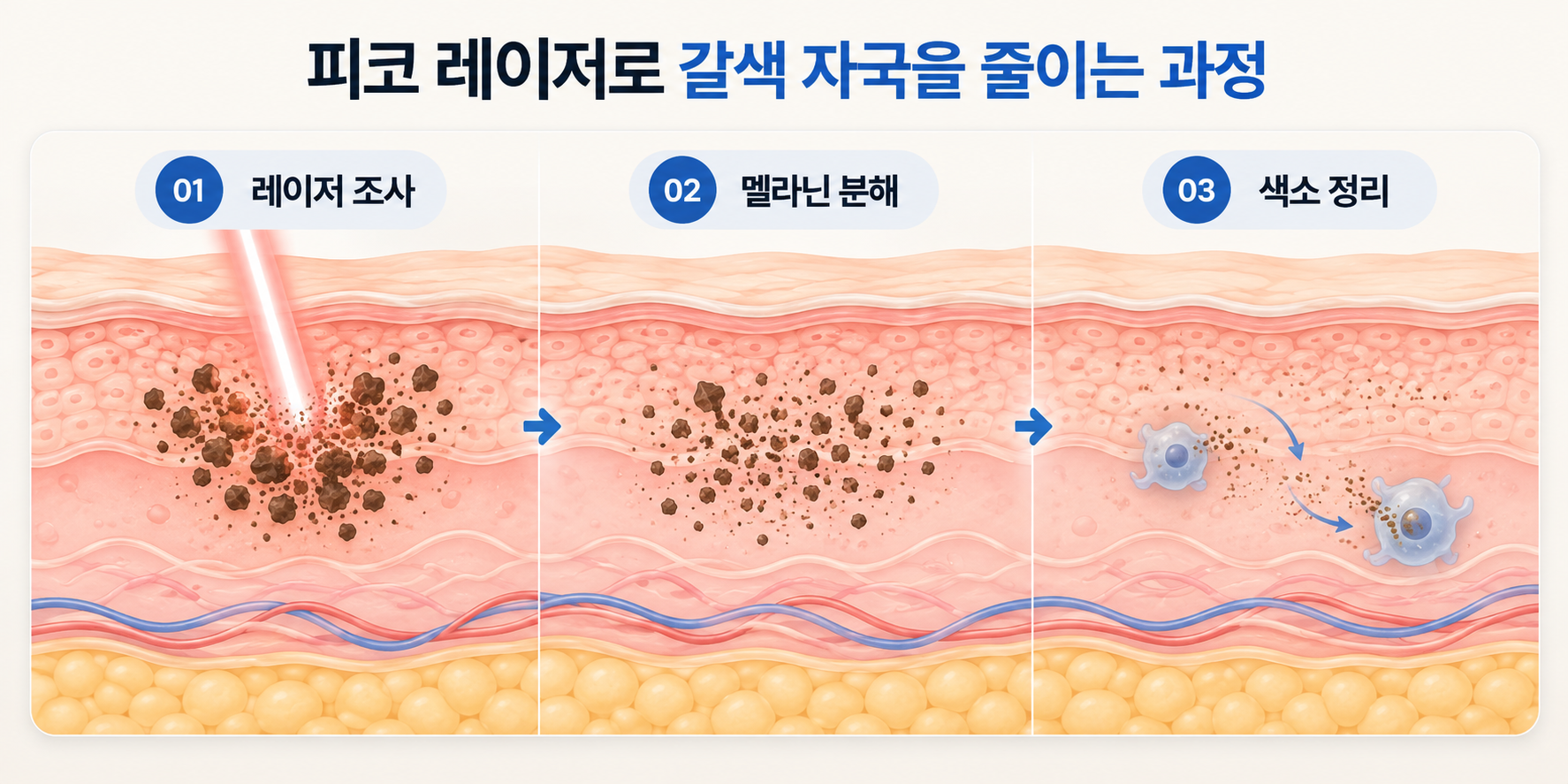 피코 레이저 조사 후 멜라닌이 잘게 분해되고 색소가 정리되는 과정