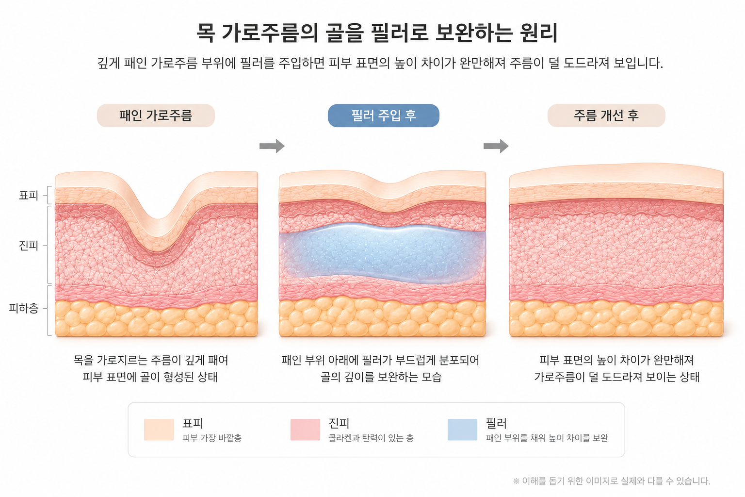 깊게 패인 목 가로주름 아래 필러가 분포되어 피부 표면의 높이 차이가 완만해지는 원리 도해