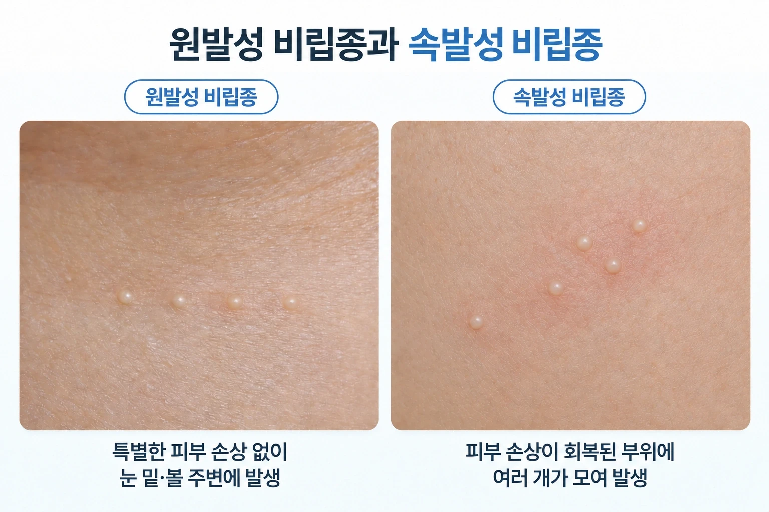 원발성 비립종은 눈 밑과 볼 주변에 흰 돌기가 흩어져 있고 속발성 비립종은 피부 손상 후 회복된 부위에 여러 개가 모여 있는 양상