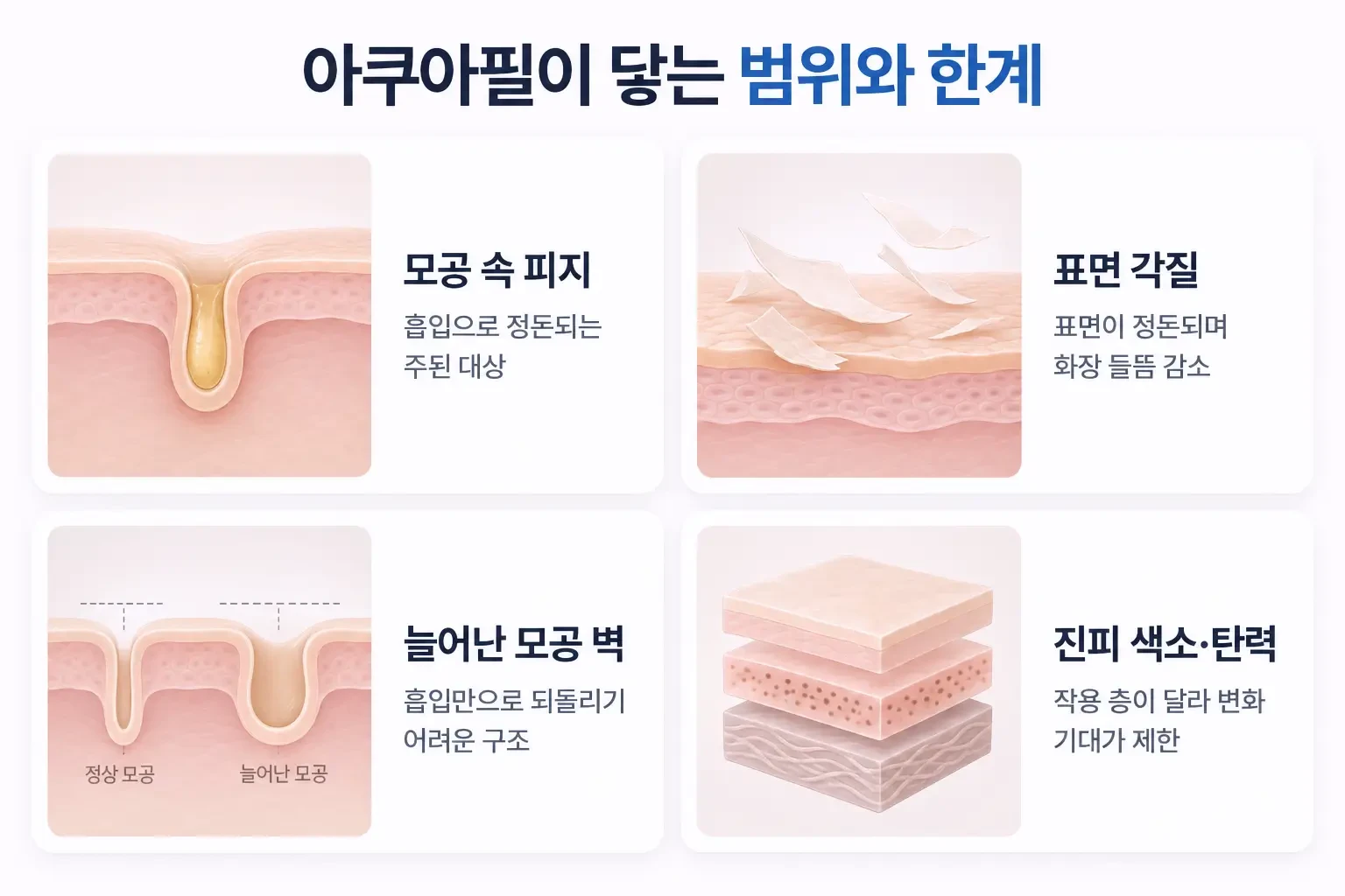 모공 속 피지, 늘어난 모공 벽, 진피 색소의 깊이를 층별로 비교한 관리 범위 카드
