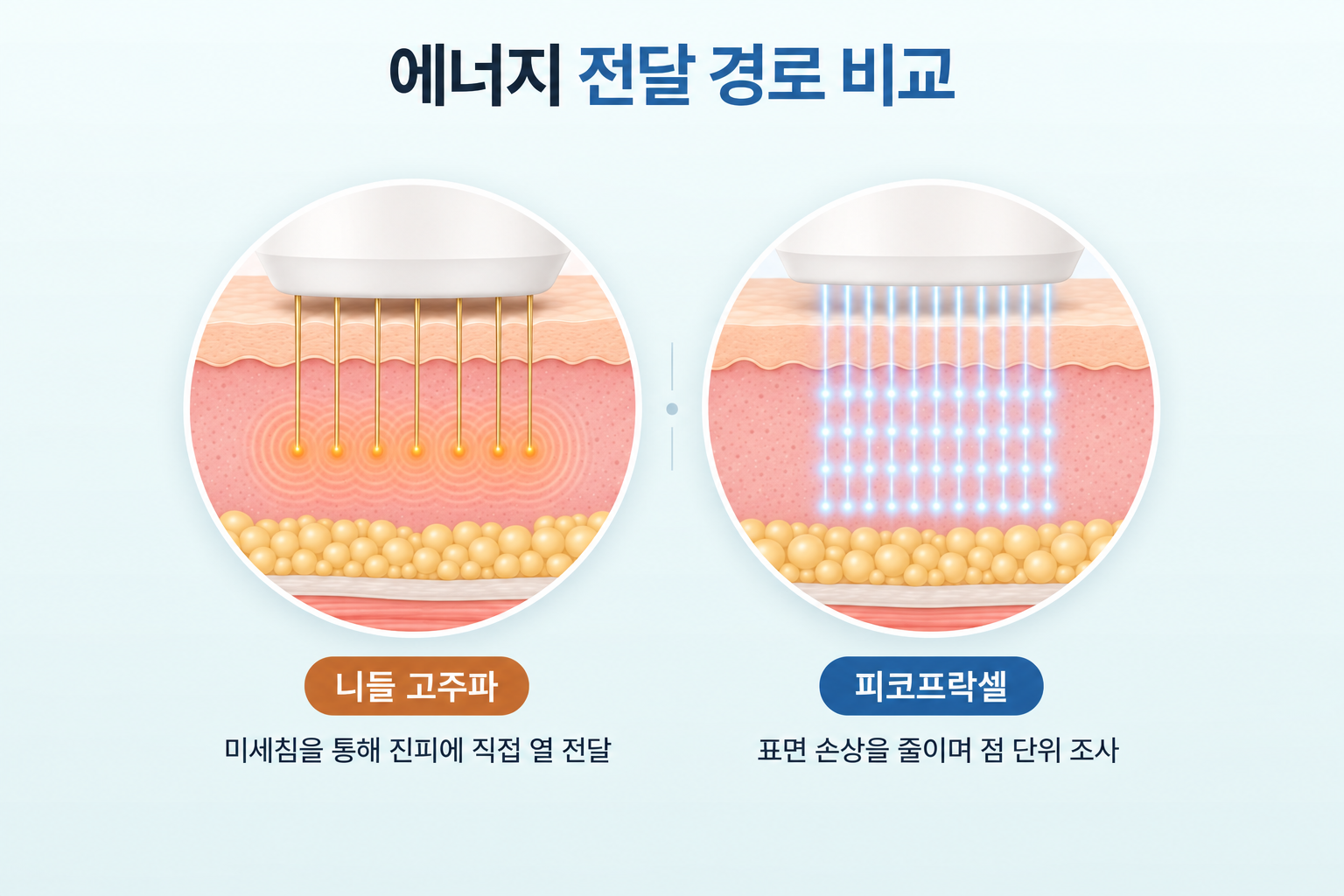 니들 고주파와 피코프락셀의 피부 에너지 전달 방식 비교