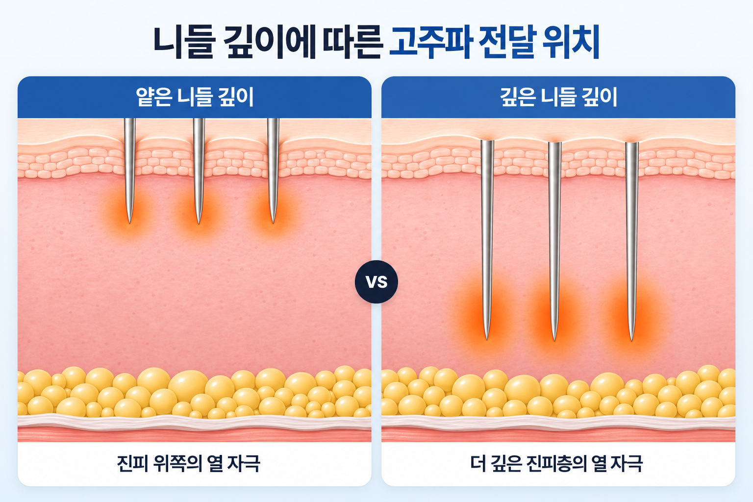 포텐자 니들 삽입 깊이에 따라 얕은 진피층과 깊은 진피층에 고주파 열이 전달되는 위치와 범위의 차이