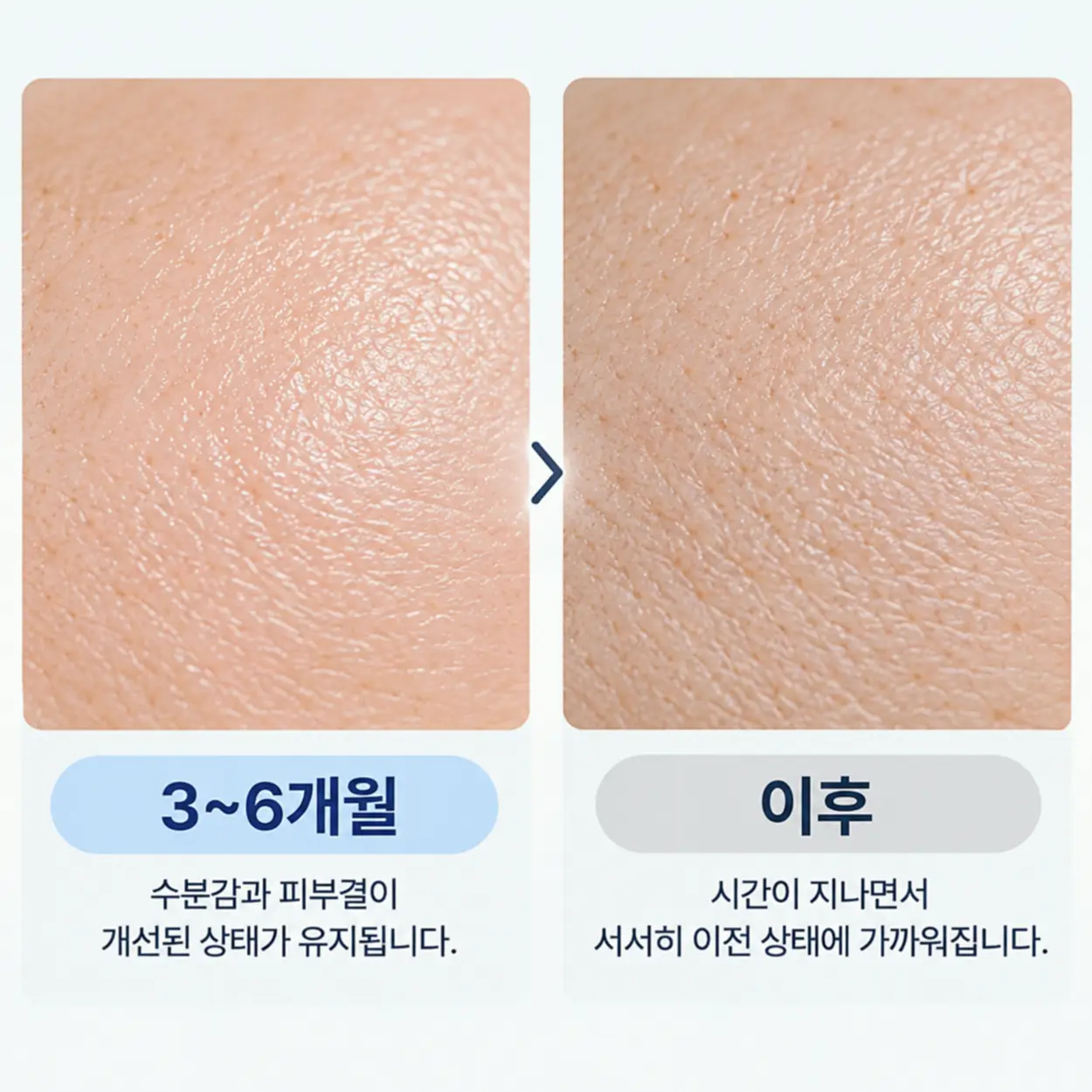 리쥬란힐러 전후 효과가 유지되는 기간