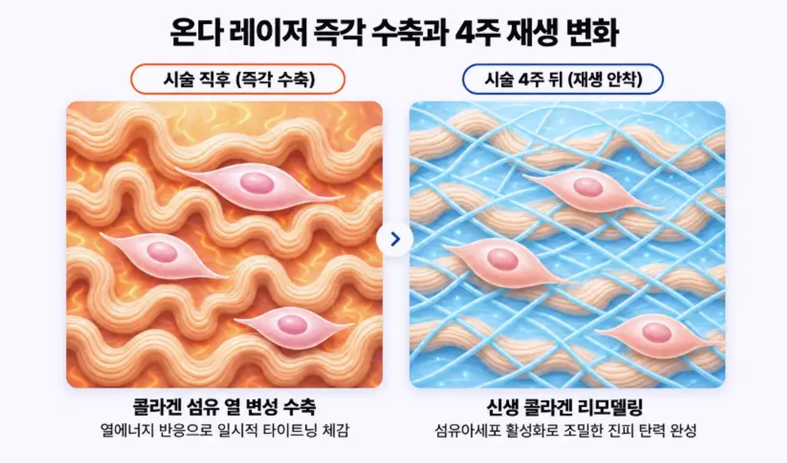 온다 레이저 시술 직후 발생하는 콜라겐 섬유 열 변성 수축과 4주 후 섬유아세포 활성화에 따른 신생 콜라겐 리모델링 비교 인포그래픽